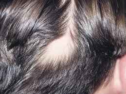Alopecia Areata 2