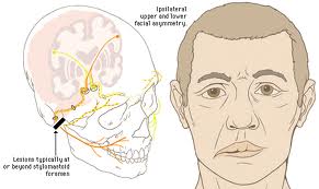 Bell's palsy 1