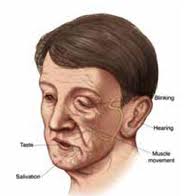Bell's palsy 2