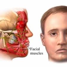Bell's palsy 5