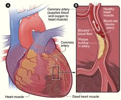 Cardiac (Heart) Disease2