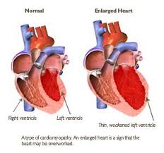 Cardiac (Heart) Disease3