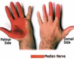 Carpal Tunnel Syndrome4