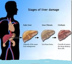 Cirrhosis of Liver4