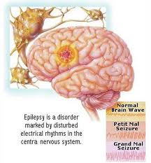 Epilepsy1