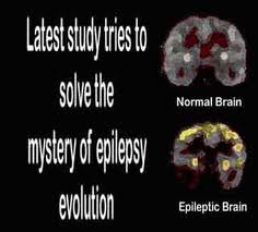 Epilepsy4