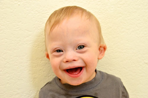 baby-down-syndrome-face-boy