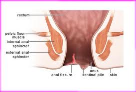 Fissure in ano