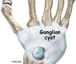 Ganglion1