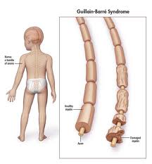 Guillain Barre Syndrome1