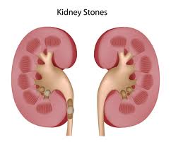 Kidney Stone1