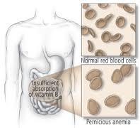 Pernicious anemia1