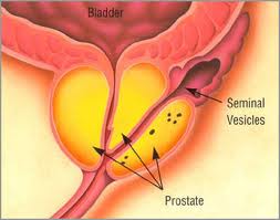 Prostate Cancer5