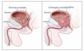 Prostate Enlargement 2