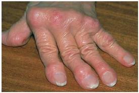 Rheumatoid Arthritis1