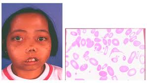 Thalassemia2