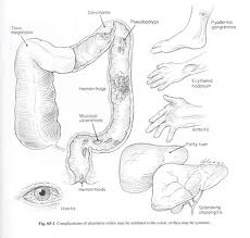 Ulcerative Colitis 3