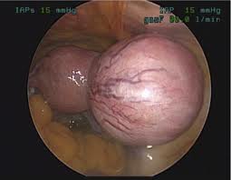 Uterine fibroid1