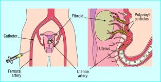Uterine fibroid4