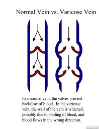 Varicose veins3